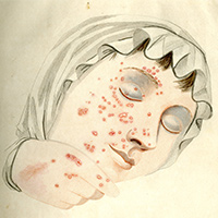 Fisher's illustration of a patient with smallpox
