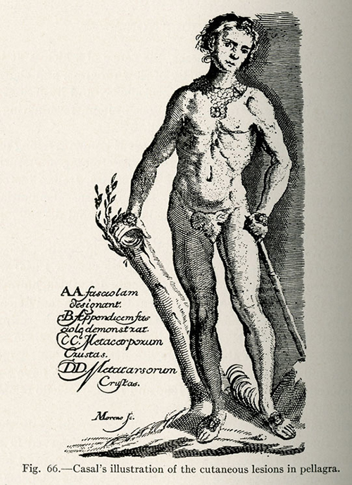 Gaspar Casal’s illustration of pellagra’s cutaneous lesions around the collar.