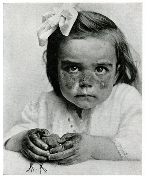 Butterfly' eruption on face of child two years old.